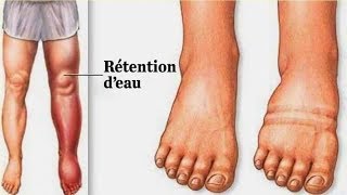 Rétention d’eau  en voici la cause et comment dégonfler les pieds et les jambes naturellement [upl. by Stratton]