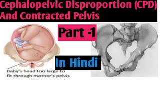 Cephalopelvic Disproportion In HindiCPDIIContracted Pelvis IICausesIINightingale Nursing Academy [upl. by Derwood]