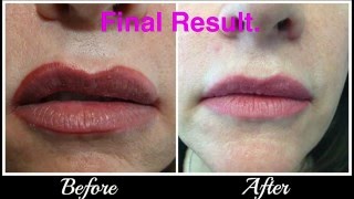 Lip tattoo CorrectionRemoval [upl. by Godden]