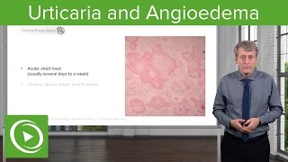 Urticaria Hives and Angioedema – Pediatrics  Lecturio [upl. by Franklyn]