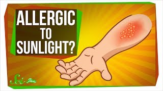 Can You Be Allergic To Sunlight [upl. by Skyla]