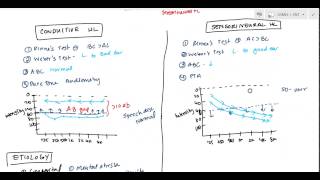 Conductive and Sensorineural Hearing Loss Deafness for USMLE [upl. by Akierdna]