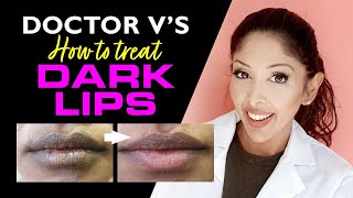 DOCTOR V How to Treat Lip Hyperpigmentation Dark Lips BROWNDARK SKIN lip pigmentation treatment [upl. by Concordia]