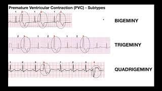 EKG Patterns  Premature Atrial amp Ventricular Contractions PACs amp PVCs [upl. by Matthew]