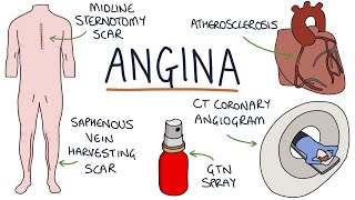 Angina Treatment Options [upl. by Teddi]