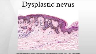 Dysplastic nevus [upl. by Nortal]