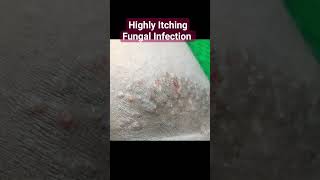 Best creams for fungal infection Skin fungus treatment Dr Ashima Goel MD ringworm treatmentTinea [upl. by Rafaello]