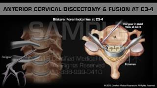 Anterior Cervical Discectomy amp Fusion at C34 [upl. by Darrin]