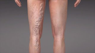 Stasis dermatitis Medical Condition [upl. by Elenahc]