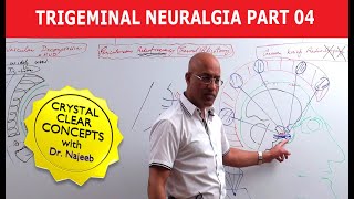 Trigeminal Neuralgia  Causes and Treatment  Part 4 [upl. by Nomead]