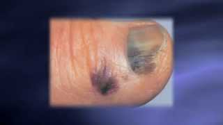 Skin Exams Catching Melanoma Earlier [upl. by Eleazar]