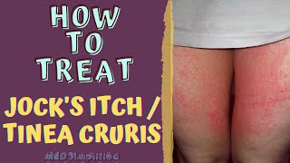 HOW TO TREAT JOCKS ITCH  TINEA CRURIS [upl. by Saraiya632]