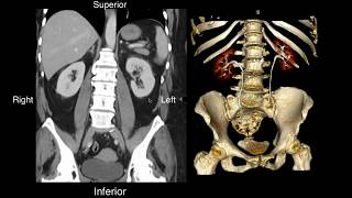 Normal Renal Anatomy [upl. by Yrffej595]