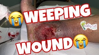 Weeping Wound [upl. by Aydidey]