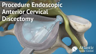 Procedure Endoscopic Anterior Cervical Discectomy [upl. by Barny566]