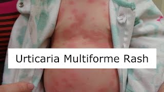 Urticaria Multiforme Rash [upl. by Htieh]