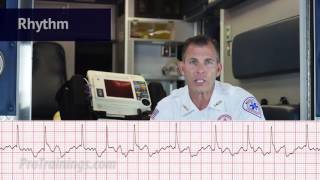 Atrial Fibrillation ECG Rhythm Interpretation [upl. by Arayc]