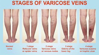 Treatment for Varicose Veins  Nucleus Health [upl. by Virgina]