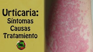 Urticaria Síntomas causas tratamiento y pronóstico [upl. by Etennaej]