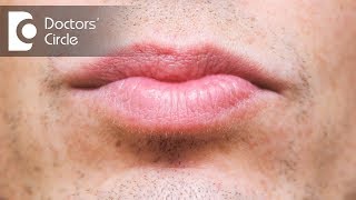 What causes discoloration below lip amp its management  Dr Sachith Abraham [upl. by Elohcin]