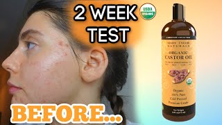 I TESTED PURE CASTOR OIL ON MY FACE FOR MY ACNE SCARS FOR 2 WEEKS  My review and thoughts [upl. by Gwendolin]