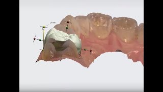 3Shape TRIOS Design Studio  Using Anatomy Design [upl. by Steven204]