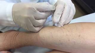 Varicose Vein Symptoms and Signs [upl. by Emylee]