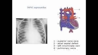 Total and Partial Anomalous Pulmonary Venous conne [upl. by Syla]