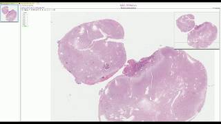 Hemangioblastoma  Adventures in Neuropathology [upl. by Dnarb731]