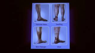 No  Knife Endovenous Laser  Animation of Scarless Varicose Vein Treatment [upl. by Cornelius]