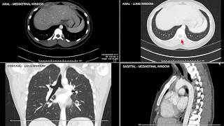 Introduction to Computed Tomographic imaging of the Chest [upl. by Chon]