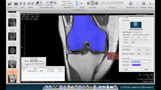 Osirix  Download and installation [upl. by Hoehne774]