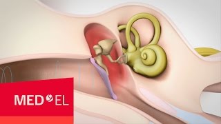 Conductive Hearing Loss Explained  MEDEL [upl. by Nomar]