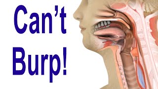 Inability to Burp Retrograde Cricopharyngeus Dysfunction RCPD [upl. by Aynatal]