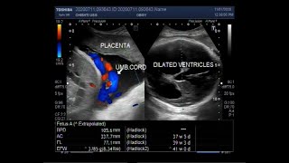 Ultrasound Video showing Cephalopelvic disproportion due to Hydrocephalus [upl. by Rapsac]