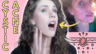 What Is Cystic Acne Causes Treatment  Cassandra Bankson [upl. by Voltmer354]