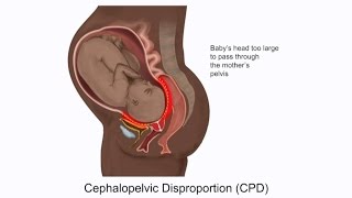 Cephalopelvic Disproportion CPD and Birth Injury [upl. by Darnell]