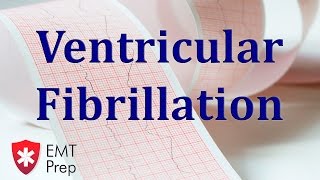 Ventricular Fibrillation ECG  EMTprepcom [upl. by Stonwin]