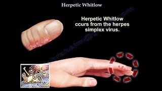 Herpetic Keratitis  Pathogenesis and Clinical Presentation Part I [upl. by Suicul837]