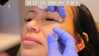 Botox Brow Lift [upl. by Zenas]