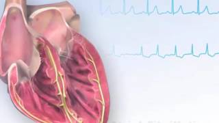 American Heart Association AHA Atrial Fibrillation Animation [upl. by Magnien]