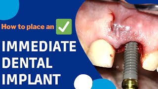 How is an IMMEDIATE DENTAL IMPLANT surgery done implants [upl. by Ennoid]