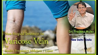 Latest Varicose Vein Treatment [upl. by Buseck]