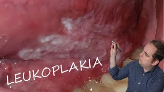 Leukoplakia Common Oral Pathology [upl. by Haonam]