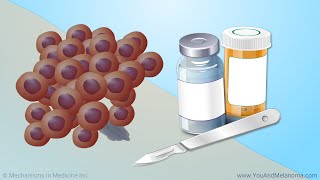 Treating Melanoma [upl. by Fredrika562]