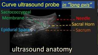 Ultrasound guided Caudal epidural block [upl. by Iat]