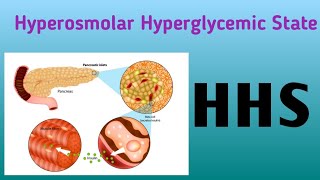 Hyperosmolar Hyperglycemic State  HHS [upl. by Ibok]