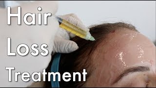 Hair Loss Treatment PRP [upl. by Mairim]