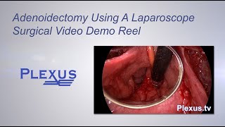 Adenoidectomy Surgical Video [upl. by Yniatirb]