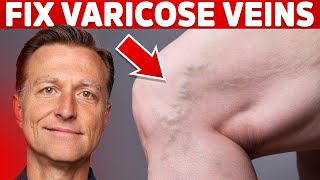 How to treat Varicose Veins and what causes them [upl. by Ritter612]